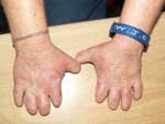 Severe changes in the hands of a patient with homozygous VP