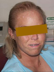 Face of a patient with HVP