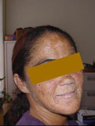 Face of a patient with HVP